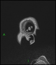 CNS manifestations of NF1 - optic pathway glioma, neurofibroma, dural ectasia (Radiopaedia 37874-39805 Sagittal FLAIR 8).jpg