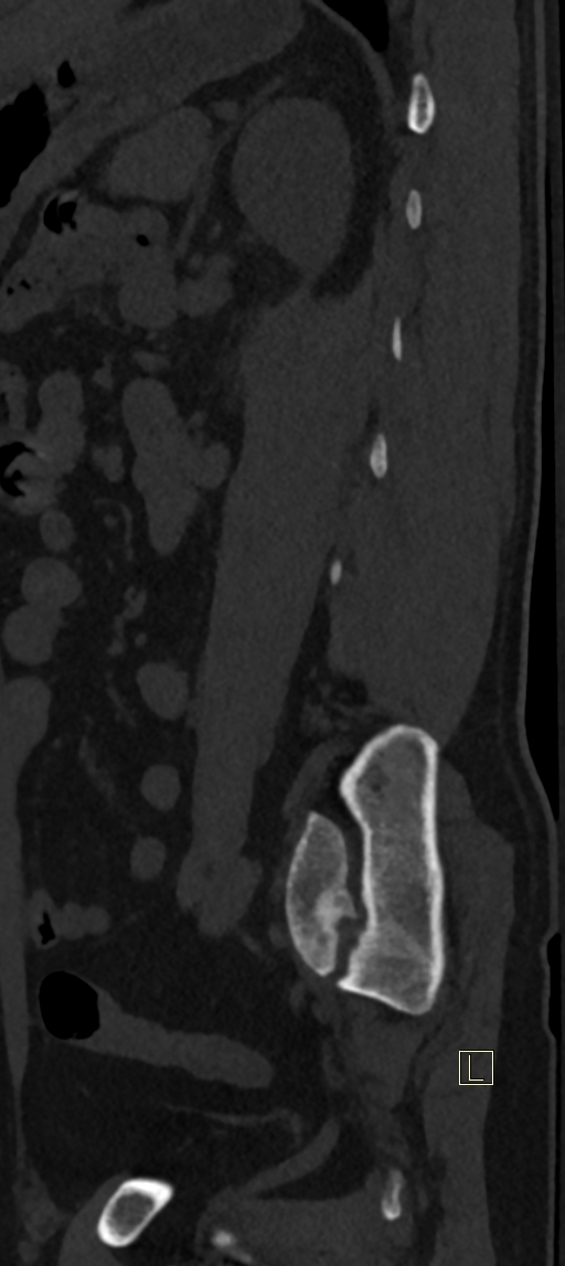Calcaneal fractures with associated L2 burst fracture (Radiopaedia 71671-82493 Sagittal bone window 7).jpg