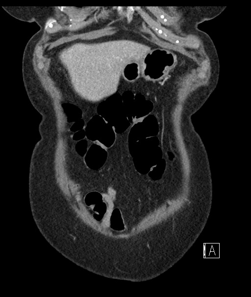 Calcified adrenal glands and Spigelian hernia (Radiopaedia 49741-54988 B 17).jpg