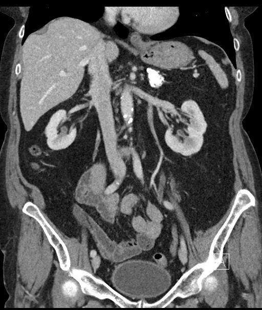 Calcified adrenal glands and Spigelian hernia (Radiopaedia 49741-54988 B 56).jpg