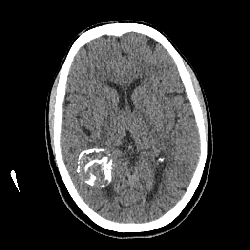 File:Calcified cerebral hydatid cyst (Radiopaedia 65603-74717 Axial non-contrast 36).jpg