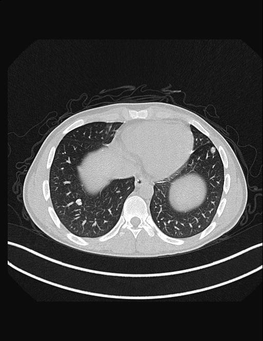 Calcifying pulmonary metastases (Radiopaedia 33359-34396 Axial lung window 48).jpg