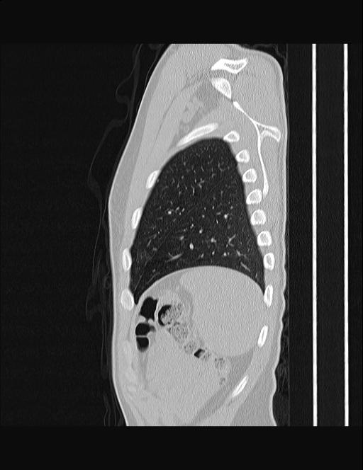 Calcifying pulmonary metastases (Radiopaedia 33359-34396 Sagittal lung window 10).jpg