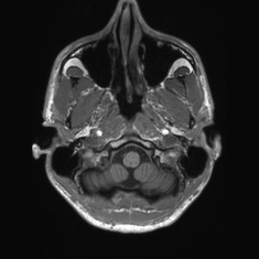 Callosal dysgenesis with interhemispheric cyst (Radiopaedia 53355-59335 Axial T1 16).jpg