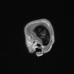 Callosal dysgenesis with interhemispheric cyst (Radiopaedia 53355-59335 Sagittal T1 13).jpg