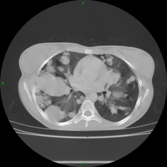 File:Cannon ball metastases - synovial sarcoma (Radiopaedia 26135-26271 Axial lung window 19).jpg