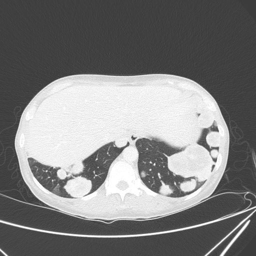 Canonball lung metastasis (Radiopaedia 77634-89837 Axial lung window 155).jpg