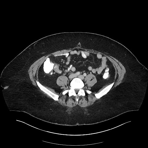 Carcinoid tumor - terminal ileum (Radiopaedia 60931-68739 A 86).jpg