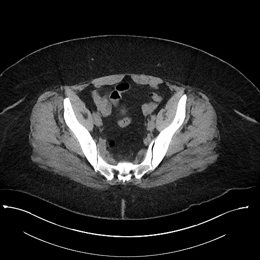 Carcinoid tumor - terminal ileum (Radiopaedia 60931-68740 Axial non-contrast 99).jpg