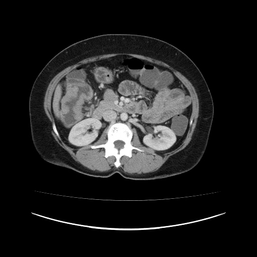 Carcinoma colon - hepatic flexure (Radiopaedia 19461-19493 A 54).jpg