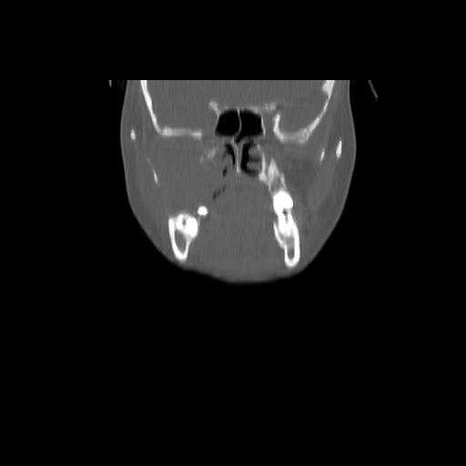 Carcinoma of the maxillary antrum (Radiopaedia 53805-59888 Coronal bone window 54).jpg