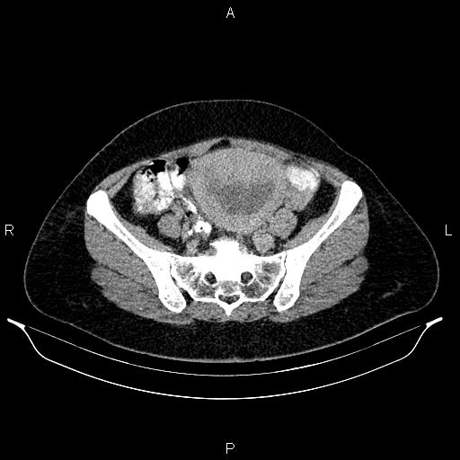 File:Carcinoma of uterine cervix (Radiopaedia 85861-101700 Axial C+ delayed 66).jpg