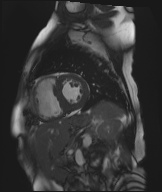 File:Cardiac amyloidosis (Radiopaedia 51404-57150 Sagittal CINE SSFP 195).jpg