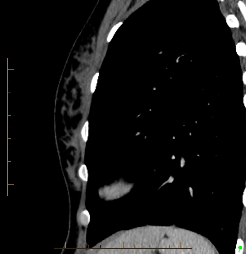 Cardiac paraganglioma (Radiopaedia 76345-88005 C 4).jpg