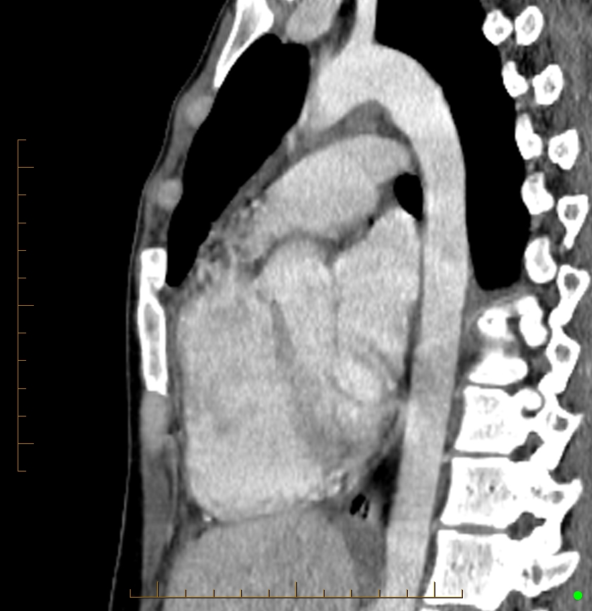 Cardiac paraganglioma (Radiopaedia 76345-88005 C 49).jpg