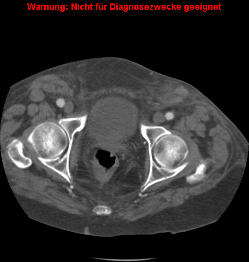 File:Cardiac perforation following transcatheter aortic valve implantation (Radiopaedia 23714-23863 B 7).png