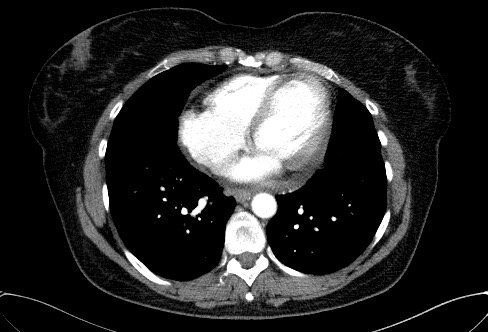 File:Cardiac sarcoidosis (Radiopaedia 74548-85534 A 60).jpg