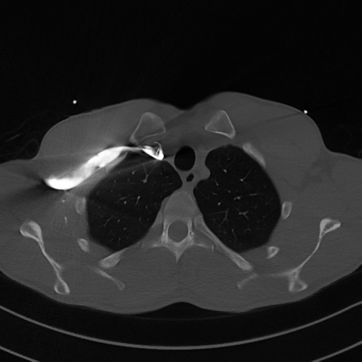 Cardiac tumor - undifferentiated pleomorphic sarcoma (Radiopaedia 45844-50134 Axial bone window 12).png
