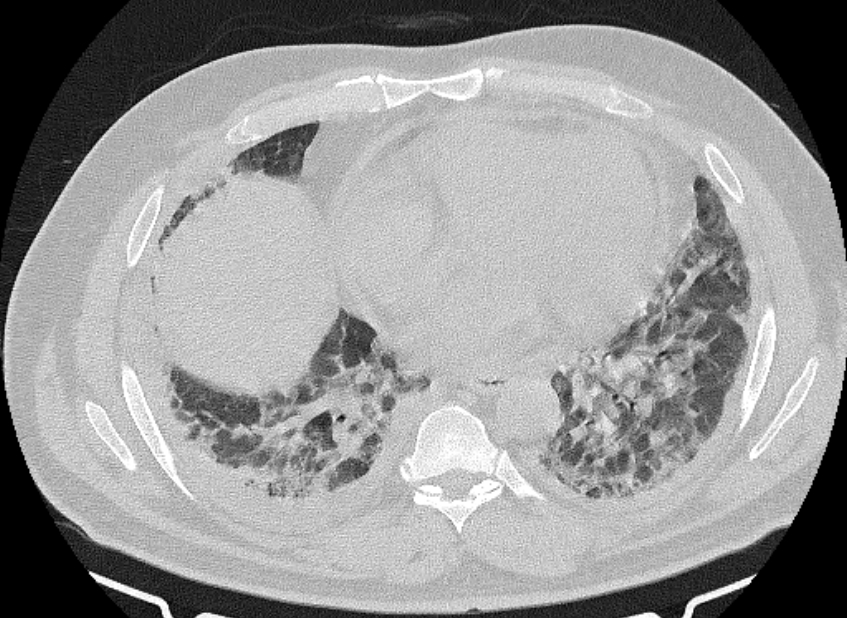 Cardiogenic pulmonary edema (Radiopaedia 68180-77678 Axial lung window 64).jpg