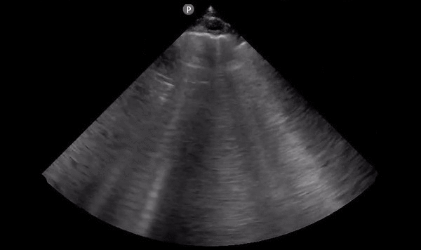 File:Cardiogenic pulmonary edema (ultrasound) (Radiopaedia 62735-71050 B 1).gif