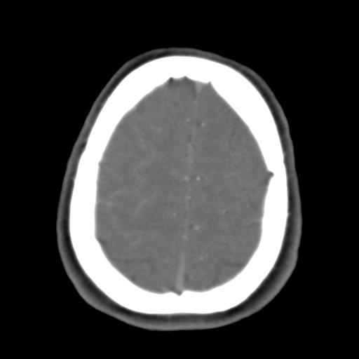 Carotico ophthalmic aneurysm (Radiopaedia 42916-46148 A 11).png
