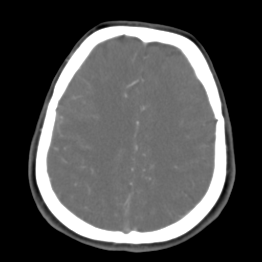 Carotico ophthalmic aneurysm (Radiopaedia 42916-46148 A 17).png