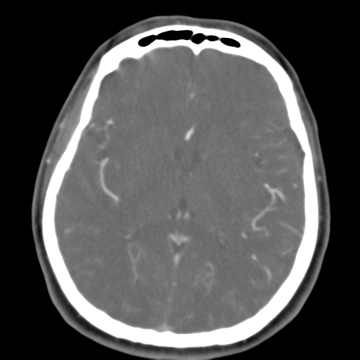 Carotico ophthalmic aneurysm (Radiopaedia 42916-46148 A 27).png