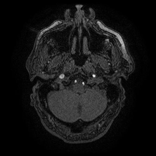Carotid arterial dissection with acute cerebral infarction (Radiopaedia 26636-26784 MRA 155).jpg