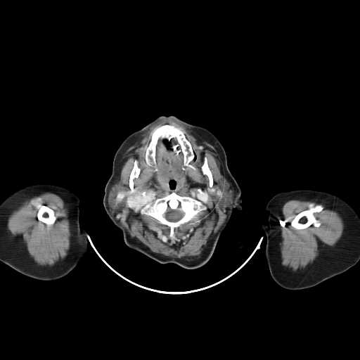 File:Carotid body tumor (Radiopaedia 21021-20948 A 13).jpg