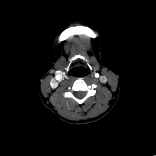 Carotid body tumor (Radiopaedia 39845-42300 B 27).jpg