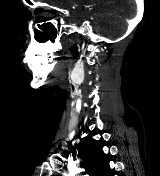 File:Carotid body tumor (Radiopaedia 39845-42300 D 45).jpg