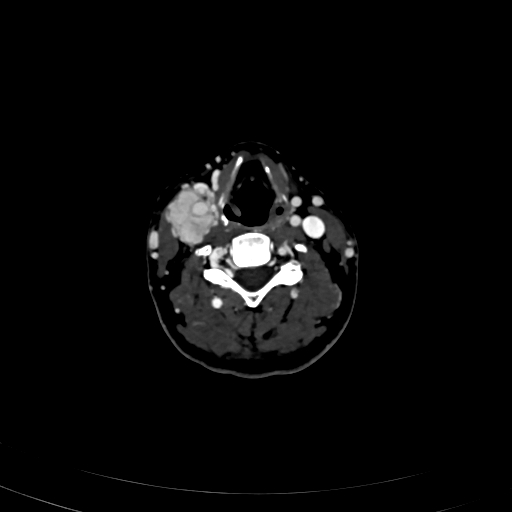 Carotid body tumor (Radiopaedia 83615-98727 D 70).jpg