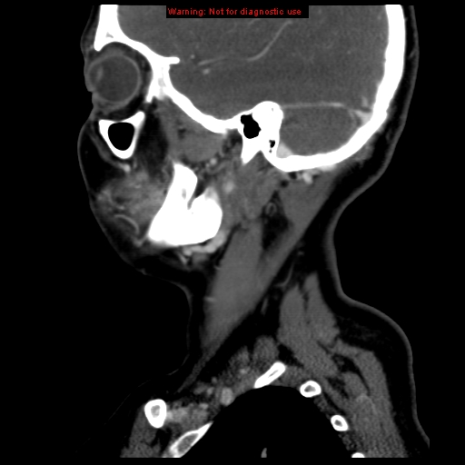 Carotid body tumor with lung metastases (Radiopaedia 9301-9986 Sagittal C+ delayed 10).jpg