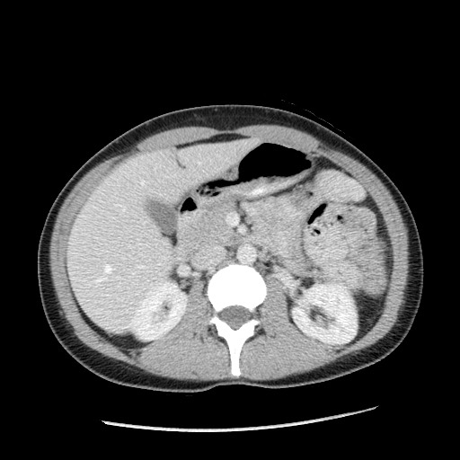 File:Castleman disease with fibrous pseudotumor in the abdomen (Radiopaedia 77296-89373 A 45).jpg
