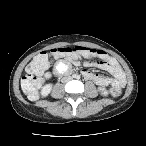 Castleman disease with fibrous pseudotumor in the abdomen (Radiopaedia 77296-89373 A 69).jpg
