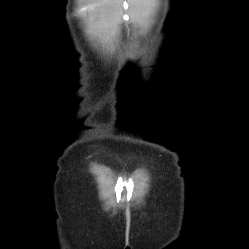 Castleman disease with fibrous pseudotumor in the abdomen (Radiopaedia 77296-89373 B 90).jpg
