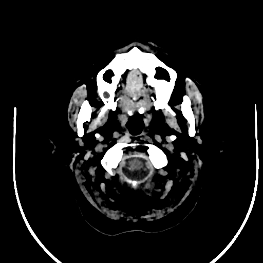 Cavernous hemangioma of the cerebellar falx (Radiopaedia 73025-83723 Axial non-contrast 1).jpg