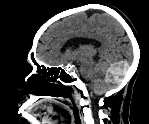 Cavernous hemangioma of the cerebellar falx (Radiopaedia 73025-83723 B 145).jpg