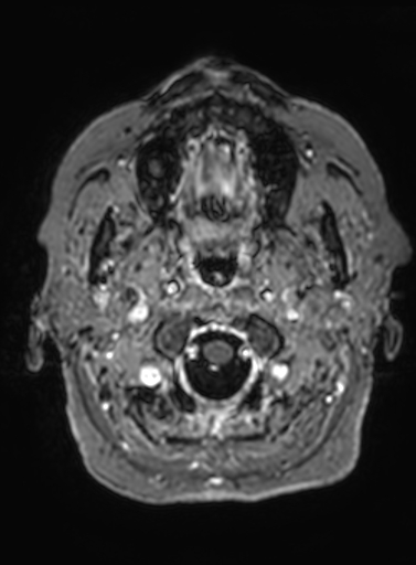 File:Cavernous hemangioma of the cerebellar falx (Radiopaedia 73025-83724 Axial T1 C+ 324).jpg
