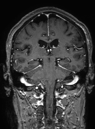Cavernous hemangioma of the cerebellar falx (Radiopaedia 73025-83724 Coronal T1 C+ 228).jpg