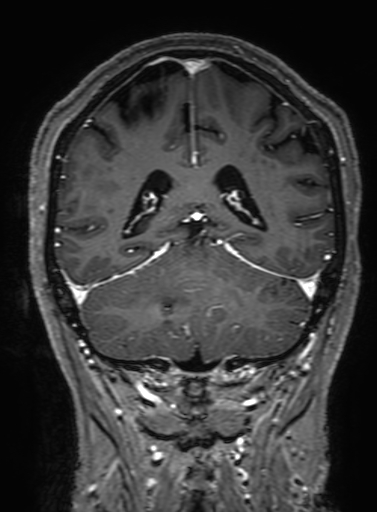 Cavernous hemangioma of the cerebellar falx (Radiopaedia 73025-83724 Coronal T1 C+ 262).jpg