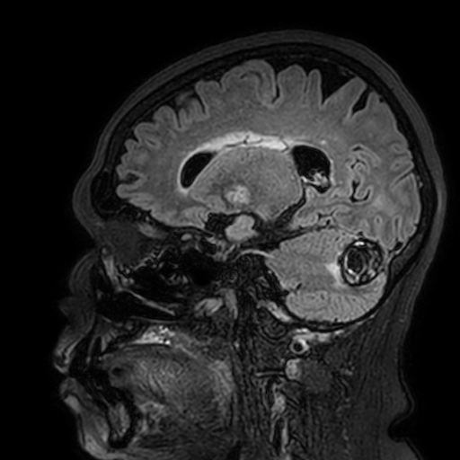 Cavernous hemangioma of the cerebellar falx (Radiopaedia 73025-83724 Sagittal FLAIR 78).jpg