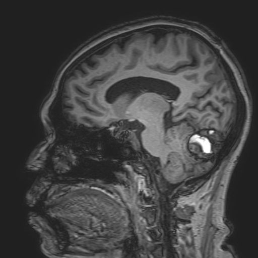 File:Cavernous hemangioma of the cerebellar falx (Radiopaedia 73025-83724 Sagittal T1 93).jpg