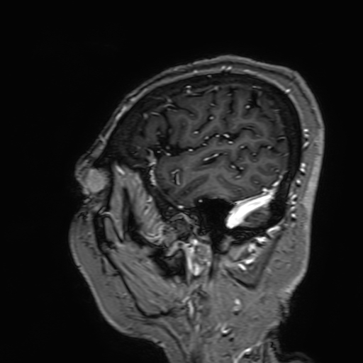 Cavernous hemangioma of the cerebellar falx (Radiopaedia 73025-83724 Sagittal T1 C+ 31).jpg