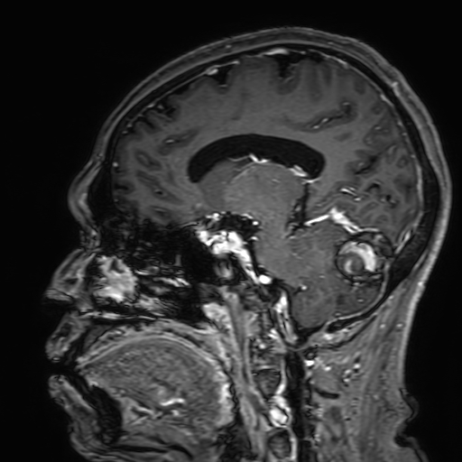 Cavernous hemangioma of the cerebellar falx (Radiopaedia 73025-83724 Sagittal T1 C+ 90).jpg