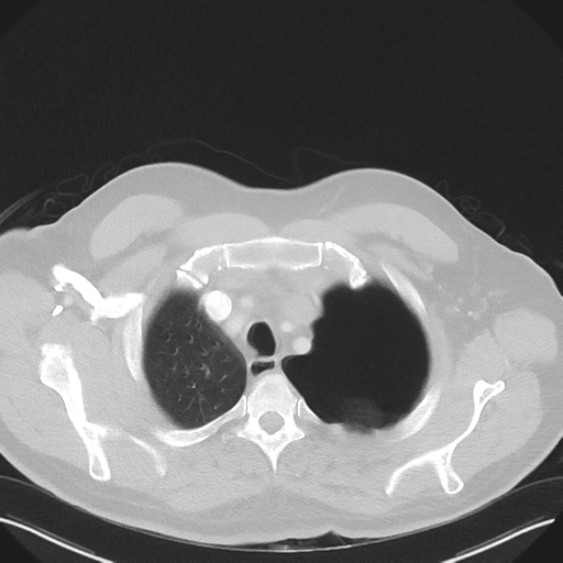 Cavitating pneumonia complicated by pneumothorax (Radiopaedia 48149-52994 Axial lung window 11).png