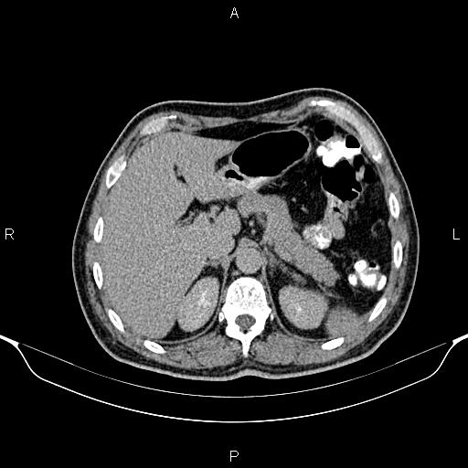 Cecal adenocarcinoma (Radiopaedia 85324-100916 Axial C+ delayed 24).jpg