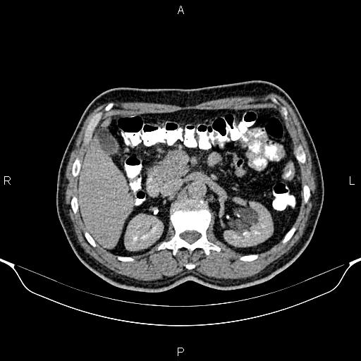 Cecal adenocarcinoma (Radiopaedia 85324-100916 Axial C+ delayed 34).jpg
