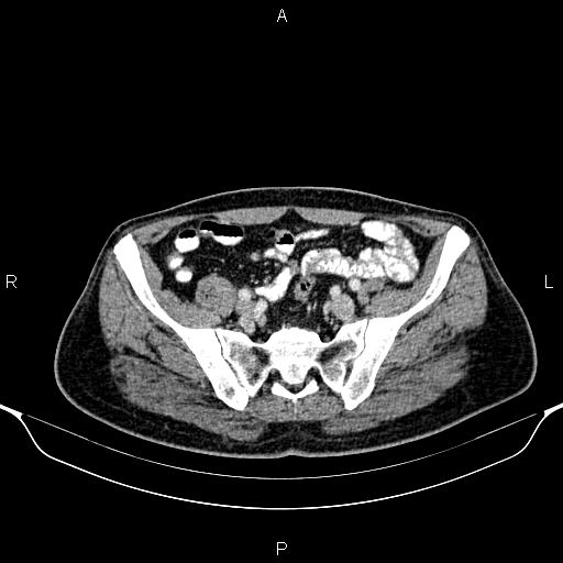 Cecal adenocarcinoma (Radiopaedia 85324-100916 B 75).jpg