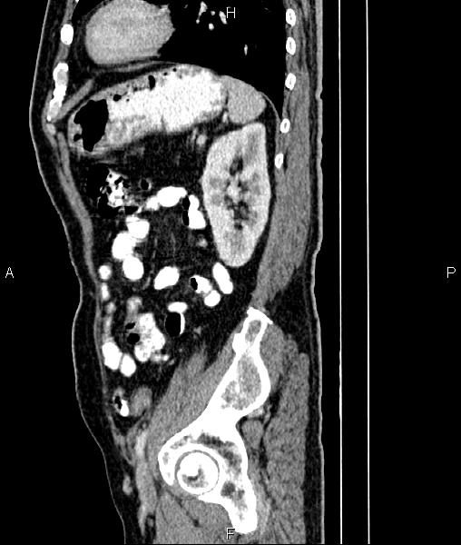 File:Cecal cancer with appendiceal mucocele (Radiopaedia 91080-108651 E 72).jpg